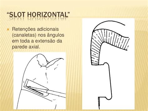 Ranhura vertical e horizontal dentistica